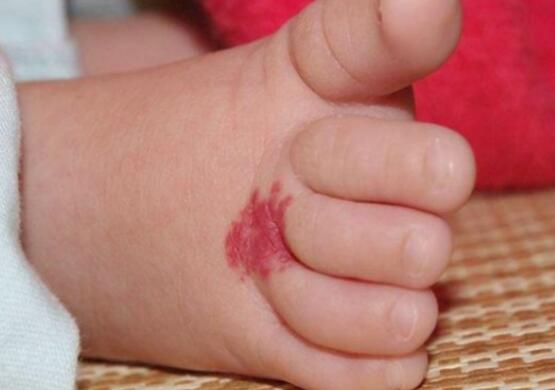 關於胎記是上輩子死亡畱下的傷嗎的信息